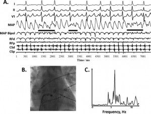 Electrogram